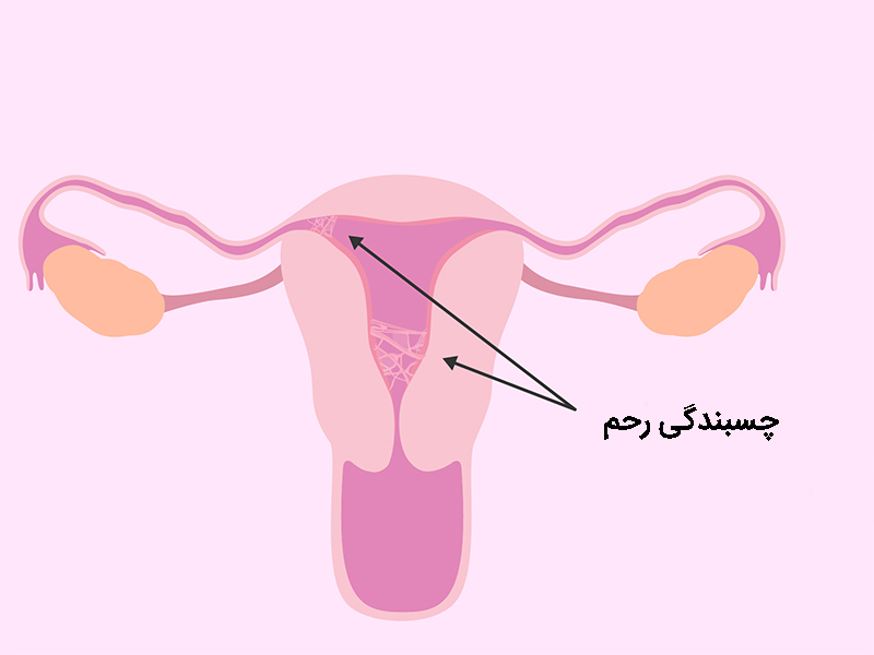 چسبندگی رحم چیست؟ چسبندگی رحم چیست؟